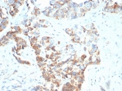 IHC staining of FFPE human gastric carcinoma with TNFRSF17 antibody (clone BCMA/7253). HIER: boil tissue sections in pH 9 10mM Tris with 1mM EDTA for 20 min and allow to cool before testing.