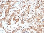 IHC staining of FFPE human colon carcinoma tissue with CD269 antibody (clone BCMA/7254). HIER: boil tissue sections in pH 9 10mM Tris with 1mM EDTA for 20 min and allow to cool before testing.