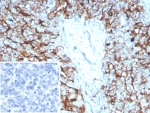 IHC staining of FFPE human ovarian cancer tissue with recombinant Mesothelin antibody (MSLN/8391R). Inset: PBS used in place of primary Ab (secondary Ab negative control). HIER: boil tissue sections in pH 9 10mM Tris with 1mM EDTA for 20 min and allow to cool before testing.