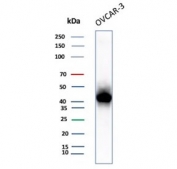 IHC staining of FFPE human ovarian cancer tissue with recombinant MSLN antibody (clone rMSLN/8764). Inset: PBS used in place of primary Ab (secondary Ab negative control). HIER: boil tissue sections in pH 9 10mM Tris with 1mM EDTA for 20 min and allow to cool before testing.