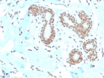 IHC staining of FFPE human breast carinoma tissue with E2F4 antibody (clone E2F4/4224). HIER: boil tissue sections in pH 9 10mM Tris with 1mM EDTA for 20 min and allow to cool before testing.