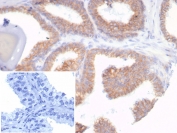 IHC staining of FFPE human prostate carcinoma tissue with recombinant CDH1 antibody (clone rCDH1/7352). Inset: PBS used in place of primary Ab (secondary Ab negative control). HIER: boil tissue sections in pH 9 10mM Tris with 1mM EDTA for 20 min and allow to cool before testing.