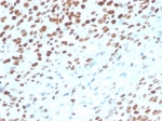 IHC staining of FFPE human bladder tissue with TP53 antibody (clone rTP53/3889). HIER: boil tissue sections in pH 9 10mM Tris with 1mM EDTA for 20 min and allow to cool before testing.