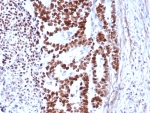 IHC staining of FFPE human colon carcinoma tissue with TP53 antibody (clone rTP53/8579). HIER: boil tissue sections in pH 9 10mM Tris with 1mM EDTA for 20 min and allow to cool before testing.