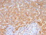 IHC staining of FFPE human hepatocellular carcinoma tissue with Haptoglobin antibody (clone HP/4815). HIER: boil tissue sections in pH 9 10mM Tris with 1mM EDTA for 20 min and allow to cool before testing.