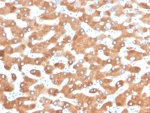 IHC staining of FFPE human liver carcinoma in colon with Haptoglobin antibody (clone HP/3832). HIER: boil tissue sections in pH 9 10mM Tris with 1mM EDTA for 20 min and allow to cool before testing.