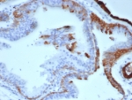 IHC staining of FFPE human prostate carcinoma tissue with Cytokeratin 14 antibody (clone KRT14/6956). HIER: boil tissue sections in pH 9 10mM Tris with 1mM EDTA for 20 min and allow to cool before testing.