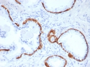 IHC staining of FFPE human prostate carcinoma tissue with Cytokeratin 14 antibody (clone KRT14/6962). HIER: boil tissue sections in pH 9 10mM Tris with 1mM EDTA for 20 min and allow to cool before testing.