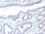 IHC staining of FFPE human colon carcinoma tissue with recombinant TP53 antibody (clone rTP53/8993). HIER: boil tissue sections in pH 9 10mM Tris with 1mM EDTA for 20 min and allow to cool before testing.