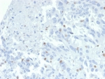 IHC staining of FFPE human tumor tissue (unknown origin) with ZNF232 antibody (clone PCRP-ZNF232-2B3). HIER: boil tissue sections in pH 9 10mM Tris with 1mM EDTA for 20 min and allow to cool before testing.