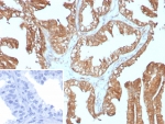 IHC staining of FFPE human prostate carcinoma tissue with recombinant YWHAE antibody (clone rYWHAE/8860). Inset: PBS used in place of primary Ab (secondary Ab negative control). HIER: boil tissue sections in pH 9 10mM Tris with 1mM EDTA for 20 min and allow to cool before testing.