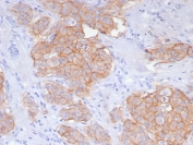 IHC staining of FFPE human breast carcinoma tissue with recombinant HER2 antibody (clone ERBB2/8142R). HIER: boil tissue sections in pH 9 10mM Tris with 1mM EDTA for 20 min and allow to cool before testing.