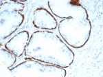 IHC staining of FFPE human prostate tissue with recombinant Cytokeratin 14 antibody (clone KRT14/7054R). HIER: boil tissue sections in pH 9 10mM Tris with 1mM EDTA for 20 min and allow to cool before testing.