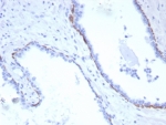 IHC staining of FFPE human prostate carcinoma tissue with recombinant Cytokeratin 17 antibody (clone KRT17/8320R). HIER: boil tissue sections in pH 9 10mM Tris with 1mM EDTA for 20 min and allow to cool before testing.