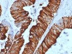 IHC staining of FFPE human colon carcinoma tissue with Cytokeratin 20 antibody (clone KRT20/7805R). HIER: boil tissue sections in pH 9 10mM Tris with 1mM EDTA for 20 min and allow to cool before testing.