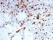 Topoisomerase II alpha Antibody Lymph Node IHC. Immunohistochemical analysis of DNA Topoisomerase II alpha (TOP2A) in formalin-fixed, paraffin-embedded human lymph node tissue using Topoisomerase II alpha antibody clone TOP2A/8103R. Strong nuclear HRP-DAB brown staining is observed in proliferating lymphocytes, with enrichment in germinal center regions, consistent with elevated expression during active cell division. HIER: boil tissue sections in pH 9 Tris-EDTA buffer for 20 min followed by cooling prior to staining.