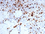 IHC staining of FFPE human lymph node tissue with Topoisomerase II alpha antibody (clone TOP2A/8103R). HIER: boil tissue sections in pH 9 10mM Tris with 1mM EDTA for 20 min and allow to cool before testing.
