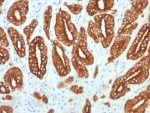 IHC staining of FFPE human prostate carcinoma tissue with Type I Cytokeratin antibody (clone KRTL/7784R). HIER: boil tissue sections in pH 9 10mM Tris with 1mM EDTA for 20 min and allow to cool before testing.