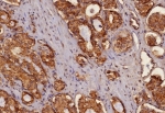 IHC staining of FFPE human prostate carcinoma tissue with Pan Cytokeratin antibody (clone MonoPoly/4999R). HIER: boil tissue sections in pH 9 10mM Tris with 1mM EDTA for 20 min and allow to cool before testing.