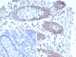 IHC staining of FFPE human colon carcinoma tissue with TBX21 antibody (clone TBX21/6724). Inset: PBS used in place of primary Ab (secondary Ab negative control). HIER: boil tissue sections in pH 9 10mM Tris with 1mM EDTA for 20 min and allow to cool before testing.