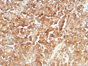 IHC staining of FFPE human melanoma tissue with recombinant NGFR antibody (clone rNGFR/8824). HIER: boil tissue sections in pH 9 10mM Tris with 1mM EDTA for 20 min and allow to cool before testing.