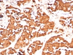 IHC staining of FFPE human pituitary tissue with GH1 antibody (clone GH/8136R). HIER: boil tissue sections in pH 9 10mM Tris with 1mM EDTA for 20 min and allow to cool before testing.