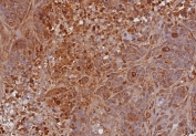 IHC staining of FFPE human bladder carcinoma tissue with TIMP2 antibody (clone TIMP2/8193R). HIER: boil tissue sections in pH 9 10mM Tris with 1mM EDTA for 20 min and allow to cool before testing.