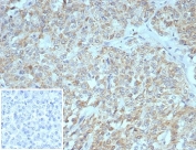 IHC staining of FFPE human pancreas tissue with SSTR2 antibody (clone SSTR2/7532). Inset: PBS used in place of primary Ab (secondary Ab negative control). HIER: boil tissue sections in pH 9 10mM Tris with 1mM EDTA for 20 min and allow to cool before testing.