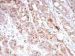 IHC staining of FFPE human colon carcinoma tissue with Survivin antibody (clone BIRC5/7775). HIER: boil tissue sections in pH 9 10mM Tris with 1mM EDTA for 20 min and allow to cool before testing.