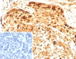 IHC staining of FFPE human ovarian cancer tissue with recombinant Survivin antibody (clone BIRC5/8936R). Inset: PBS used in place of primary Ab (secondary Ab negative control). HIER: boil tissue sections in pH 9 10mM Tris with 1mM EDTA for 20 min and allow to cool before testing.