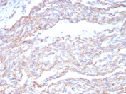 NCAD Antibody Heart Tissue IHC. Immunohistochemical analysis of N-Cadherin / CDH2 (NCAD) expression in formalin-fixed, paraffin-embedded human heart tissue using NCAD antibody clone CDH2/8815R. Predominantly membranous staining is observed in cardiomyocytes, with signal outlining cell-cell junctions consistent with localization at intercalated discs. The staining pattern highlights organized cardiac muscle fibers, while surrounding interstitial areas show low background. HIER: boil tissue sections in pH 9 10mM Tris with 1mM EDTA for 20 min and allow to cool before testing.