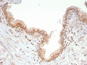 IHC staining of FFPE human prostate tissue with SMAD4 antibody (clone SMAD4/7903). HIER: boil tissue sections in pH 9 10mM Tris with 1mM EDTA for 20 min and allow to cool before testing.