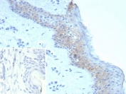 IHC staining of FFPE human skin tissue with Desmoglein 3 antibody (clone DSG3/8251R). Inset: PBS used in place of primary Ab (secondary Ab negative control). HIER: boil tissue sections in pH 9 10mM Tris with 1mM EDTA for 20 min and allow to cool before testing.