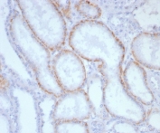 IHC staining of FFPE human renal cell carcinoma tissue with CD147 antibody (clone BSG/7953) at 2ug/ml. HIER: boil tissue sections in pH 9 10mM Tris with 1mM EDTA for 20 min and allow to cool before testing.