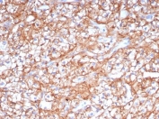 IHC staining of FFPE human renal cell carcinoma tissue with CD147 antibody (clone BSG/7954) at 2ug/ml. HIER: boil tissue sections in pH 9 10mM Tris with 1mM EDTA for 20 min and allow to cool before testing.