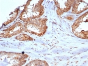 IHC staining of FFPE human prostate tissue with CARM1 antibody (clone CARM1/7426). HIER: boil tissue sections in pH 9 10mM Tris with 1mM EDTA for 20 min and allow to cool before testing.