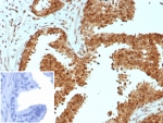 IHC staining of FFPE human prostate carcinoma tissue with CARM1 antibody (clone CARM1/7426). Inset: PBS used in place of primary Ab (secondary Ab negative control). HIER: boil tissue sections in pH 9 10mM Tris with 1mM EDTA for 20 min and allow to cool before testing.