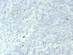 IHC staining of FFPE human ovarian small cell carcinoma with SMARCA4 antibody (clone BRG1/6531R). HIER: boil tissue sections in pH 9 10mM Tris with 1mM EDTA for 20 min and allow to cool before testing.