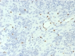 IHC staining of FFPE human ovarian small cell carcinoma with BRG1 antibody (clone BRG1/7633R). HIER: boil tissue sections in pH 9 10mM Tris with 1mM EDTA for 20 min and allow to cool before testing.