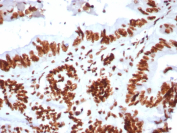 SMARCA4 Antibody Colon IHC. Immunohistochemical analysis of SMARCA4 / BRG1 in formalin-fixed, paraffin-embedded human colon tissue using SMARCA4 antibody clone BRG1/8805R. Strong nuclear HRP-DAB brown staining is observed in glandular epithelial cells lining the colonic crypts, while stromal cells show weaker signal, consistent with nuclear localization of this chromatin remodeling factor. HIER: boil tissue sections in pH 9 10 mM Tris with 1 mM EDTA for 20 min followed by cooling prior to staining.
