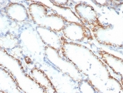 IHC staining of FFPE human renal cell carcinoma tissue with CD147 antibody (clone BSG/7949) at 2ug/ml. HIER: boil tissue sections in pH 9 10mM Tris with 1mM EDTA for 20 min and allow to cool before testing.