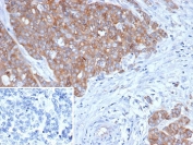 IHC staining of FFPE human ovarian cancer tissue with BRAF antibody (clone BRAF/1626). Inset: PBS used in place of primary Ab (secondary Ab negative control). HIER: boil tissue sections in pH 9 10mM Tris with 1mM EDTA for 20 min and allow to cool before testing.