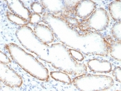 IHC staining of FFPE human renal cell carcinoma tissue with Emmprin antibody (clone BSG/7950) at 2ug/ml. HIER: boil tissue sections in pH 9 10mM Tris with 1mM EDTA for 20 min and allow to cool before testing.