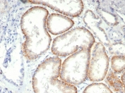 IHC staining of FFPE human renal cell carcinoma tissue with CD147 antibody (clone BSG/7951) at 2ug/ml. HIER: boil tissue sections in pH 9 10mM Tris with 1mM EDTA for 20 min and allow to cool before testing.