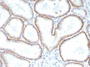 IHC staining of FFPE human renal cell carcinoma tissue with Basigin antibody (clone BSG/7952) at 2ug/ml. HIER: boil tissue sections in pH 9 10mM Tris with 1mM EDTA for 20 min and allow to cool before testing.