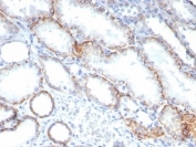 IHC staining of FFPE human renal cell carcinoma tissue with BSG antibody (clone BSG/7955) at 2ug/ml. HIER: boil tissue sections in pH 9 10mM Tris with 1mM EDTA for 20 min and allow to cool before testing.