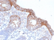 IHC staining of FFPE human colon carcinoma tissue with CD147 antibody (clone BSG/3395) at 2ug/ml. HIER: boil tissue sections in pH 9 10mM Tris with 1mM EDTA for 20 min and allow to cool before testing.
