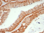 IHC staining of FFPE human colon carcinoma tissue with HAb18Gantibody (clone BSG/7957). HIER: boil tissue sections in pH 9 10mM Tris with 1mM EDTA for 20 min and allow to cool before testing.