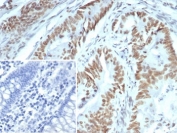 IHC staining of FFPE human colon carcinoma tissue with Upstream stimulatory factor 2 antibody (clone PCRP-USF2-1A7). Inset: PBS used in place of primary Ab (secondary Ab negative control). HIER: boil tissue sections in pH 9 10mM Tris with 1mM EDTA for 20 min and allow to cool before testing.