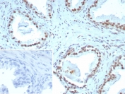 IHC staining of FFPE human prostate tissue with ERCC1 antibody (clone ERCC1/7596). Inset: PBS used in place of primary Ab (secondary Ab negative control). HIER: boil tissue sections in pH 9 10mM Tris with 1mM EDTA for 20 min and allow to cool before testing.